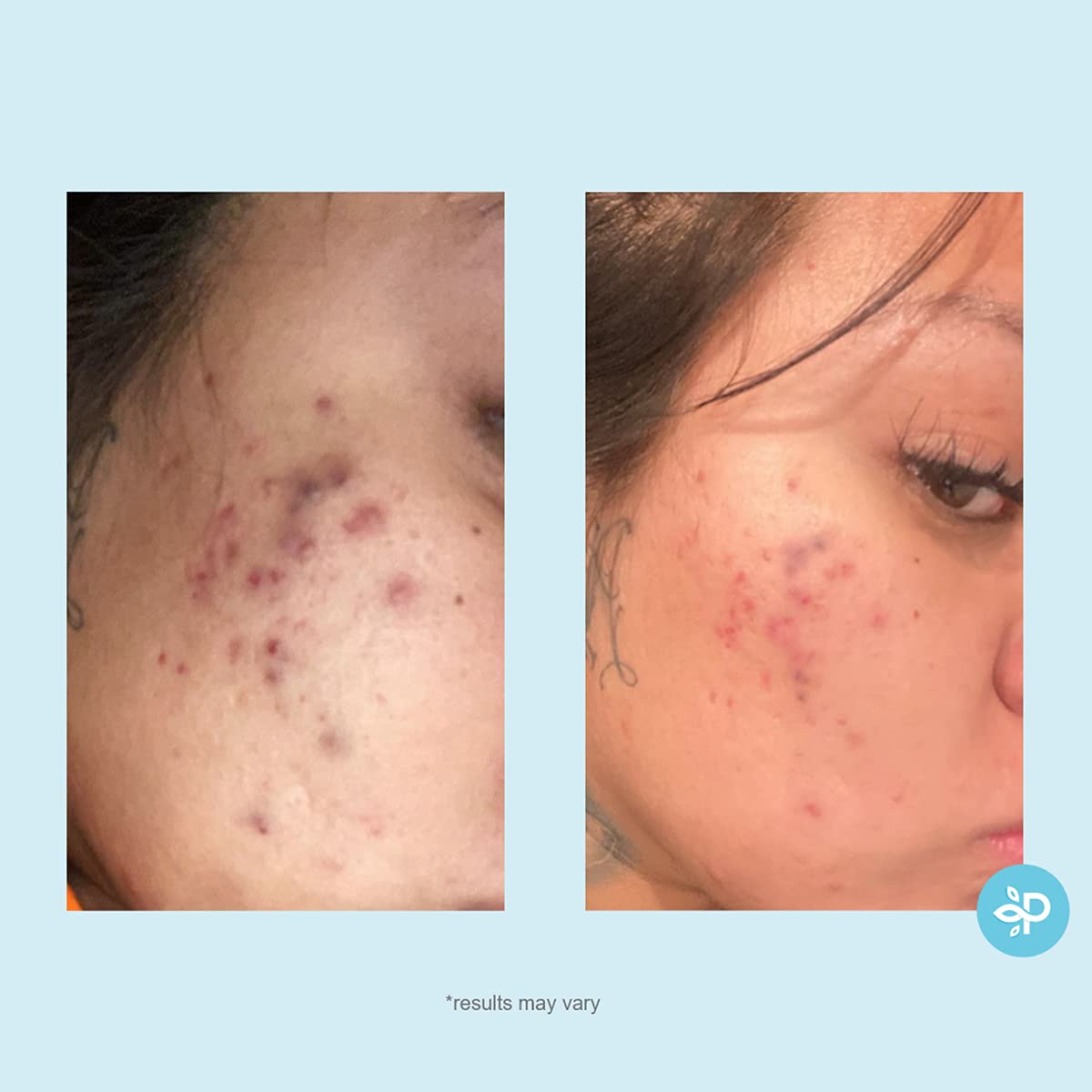 Salicylic 20% Gel Peel, Breakout and Pore Minimizer and Cleanser, 1 fl oz. e, 30 ml