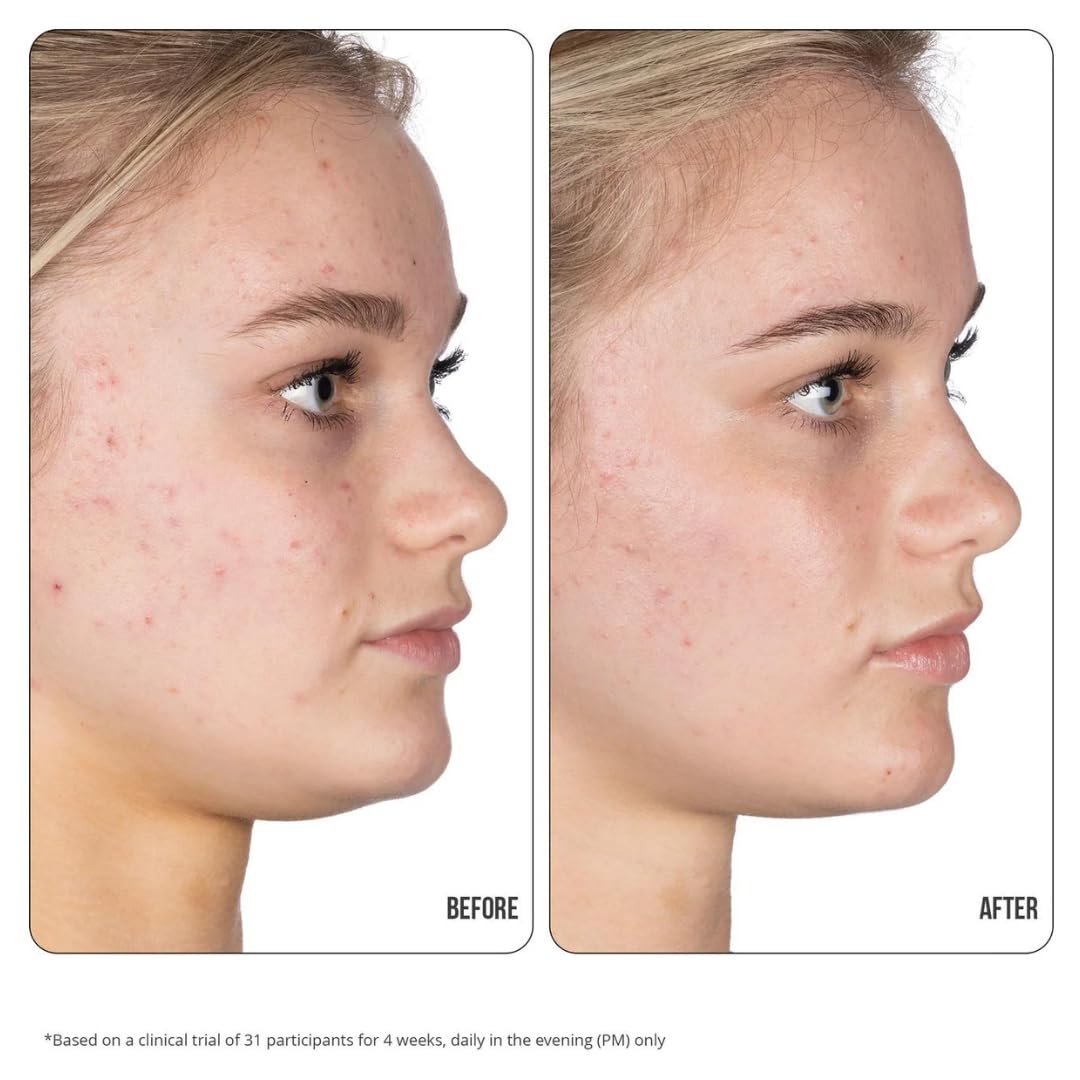 Nip+Fab Retinol Fix Blemish Gel Treatment 10% Complex - 0.5 fl. oz.