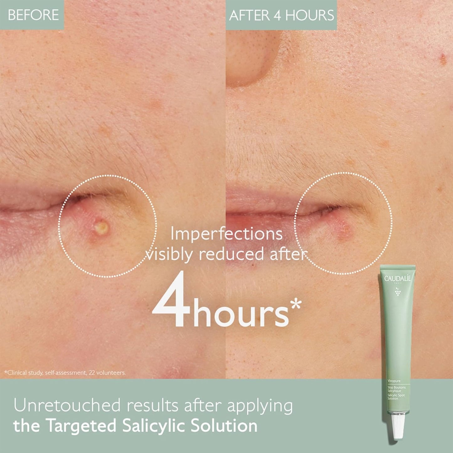 Caudalie Vinopure Color Correcting Spot Solution with Salicylic Acid