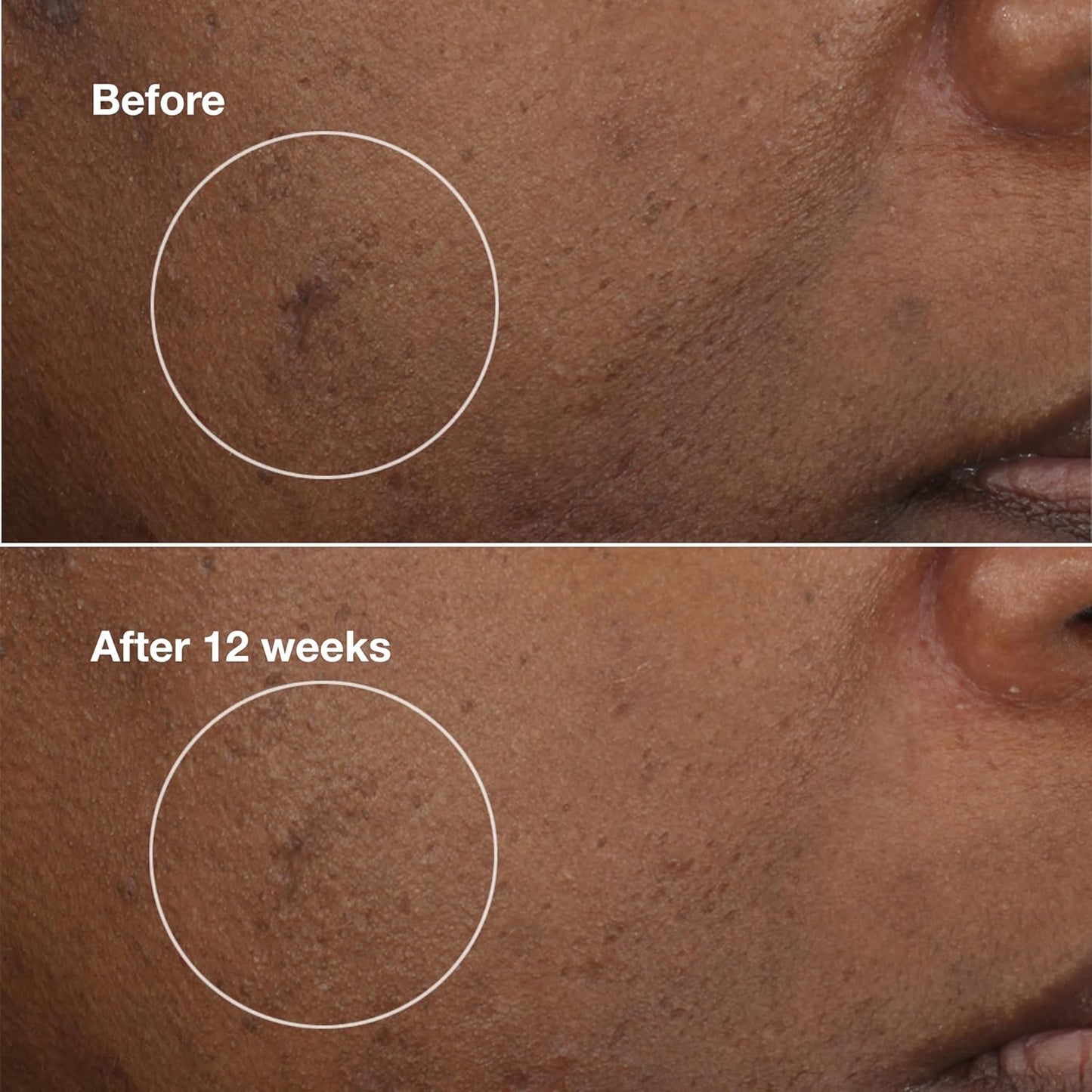 Clinique Even Better Clinical Brightening Moisturizer With Salicylic Acid