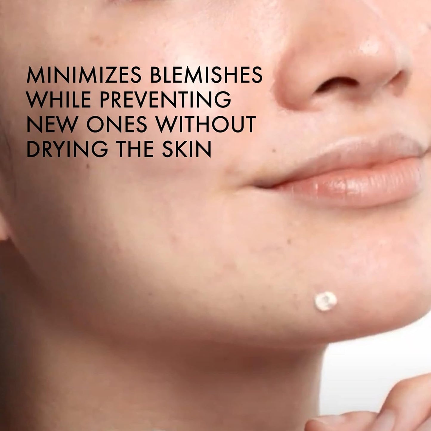 Vichy Normaderm S.O.S Acne Rescue Spot Corrector - 0.68 fl  oz