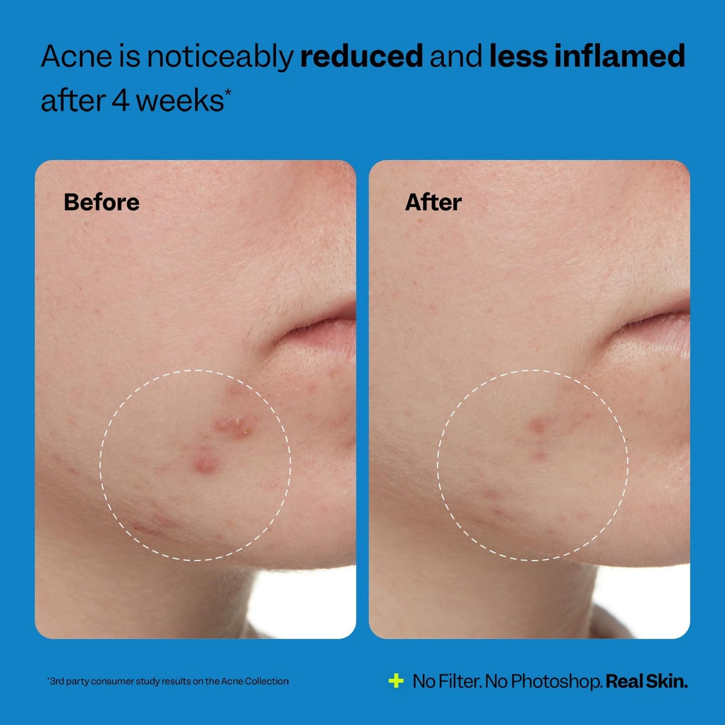 Peach Slices - Acne Exfoliating Toner (4.05 oz)