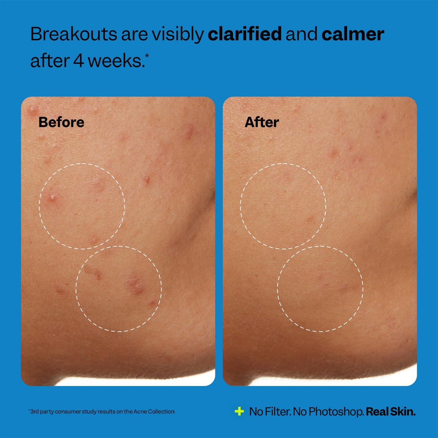 Peach Slices - Acne Clarifying Cleanser (4.05 oz)