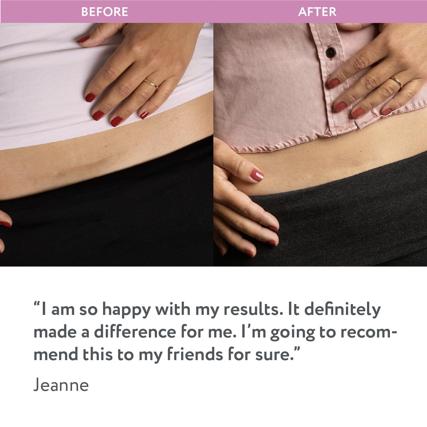 ScarAway Advanced Silicone Scar Sheets for C-Section  (1.5” x 7”) -  4 Sheets