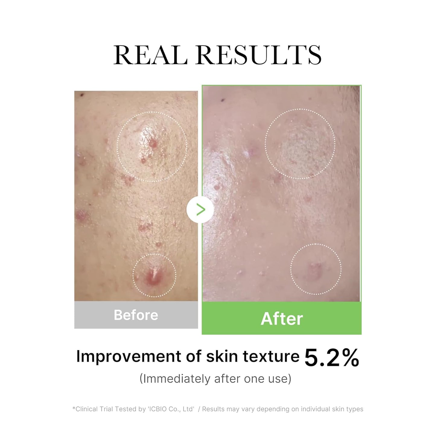 Medicube Exosome Cica Tea Tree Ampoule -  30ml