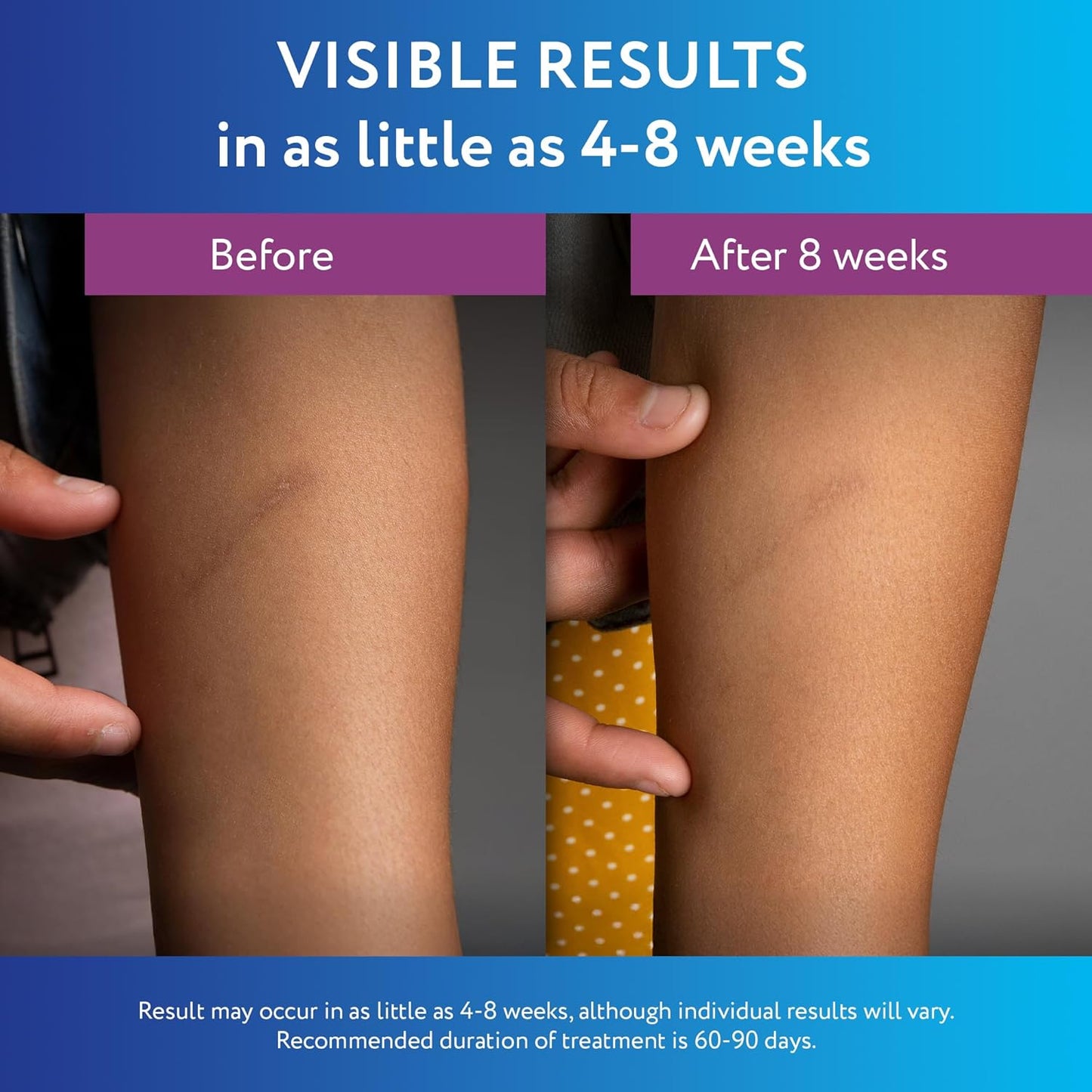 ScarAway Silicone Scar Gel - 10g (0.35 Oz)