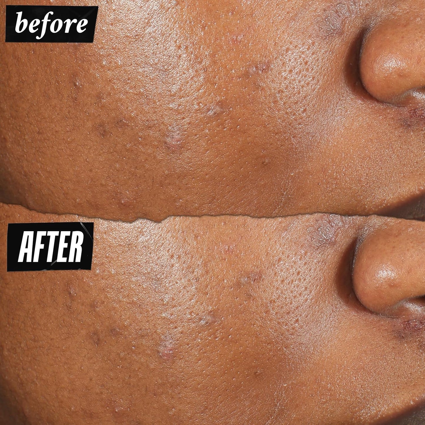 Kiehl's Truly Targeted Acne-Clearing Pimple Patch with 2% Salicylic Acid,0.5 fl oz