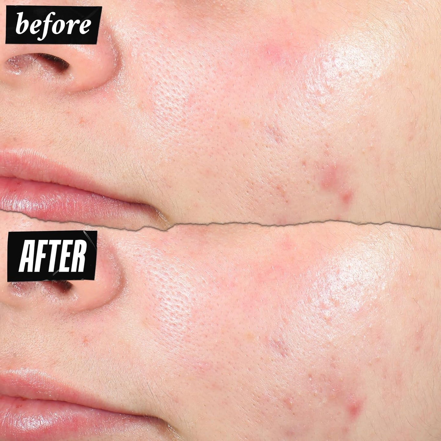 Kiehl's Truly Targeted Acne-Clearing Pimple Patch with 2% Salicylic Acid,0.5 fl oz