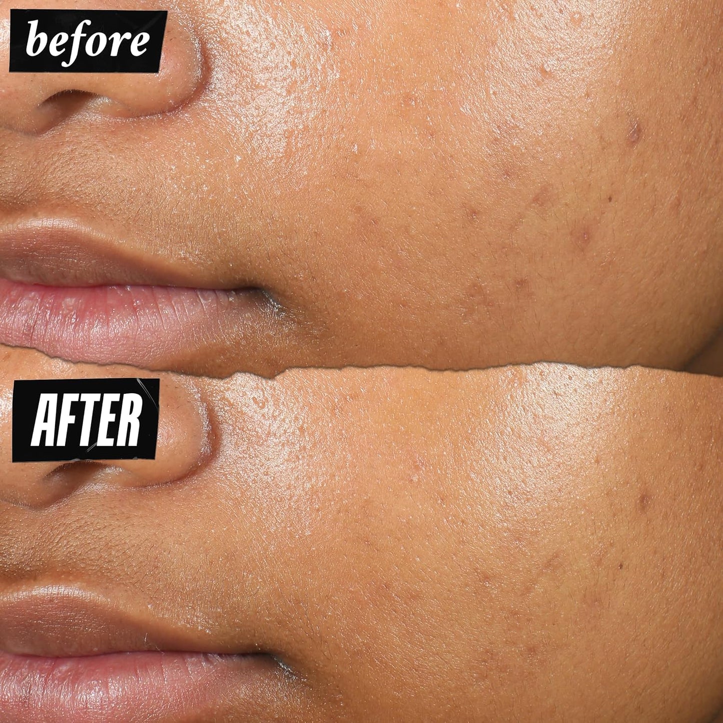 Kiehl's Truly Targeted Acne-Clearing Pimple Patch with 2% Salicylic Acid,0.5 fl oz